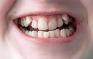 永久歯がすべて生えた直後で上顎犬歯がデコボコになっている症状