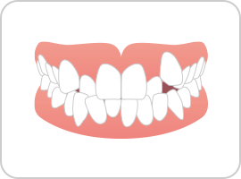 八重歯・乱抗歯（叢生）