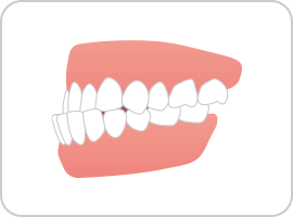 受け口（反対咬合）