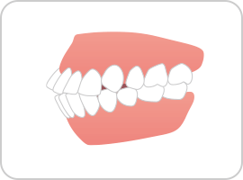 口ゴボ（上下顎前突）